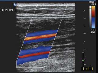 Peroneal Artery Ultrasound