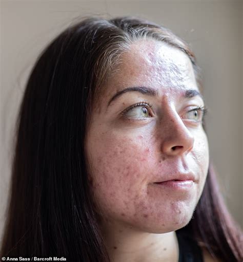 Personal trainer who had the 'worst acne ever seen' shares her striking before and after ...