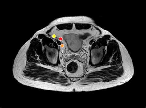 Internal Iliac Lymph Nodes