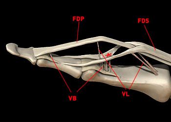 Flexor Tendon Injuries | Radsource