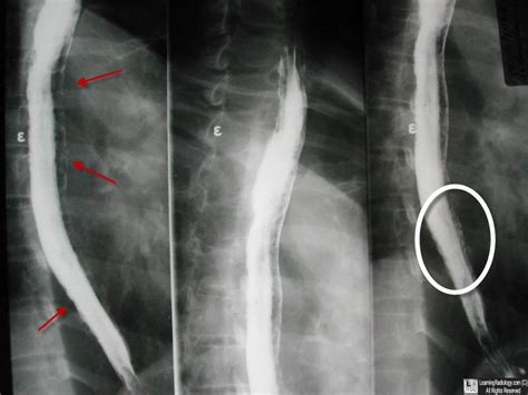 LearningRadiology - Esophageal, Candidiasis, Monilial, Esophagitis