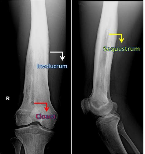 107 best OSTEOMYELITIS images on Pinterest | Radiology, Bones and Dice