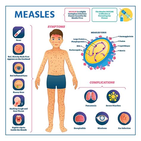 Measles: Symptoms, Causes, Treatment and Prevention