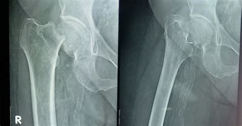 Subcapital fracture Neck Of Right Femur ~ Materialnotes.com- Staff Nurses in India, Nurses ...