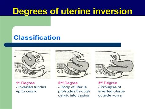 Retroverted retroflexed uterus &uterine inversion