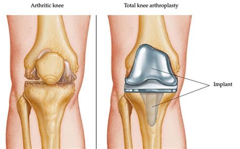 Obesity and total joint arthroplasty - Mayo Clinic