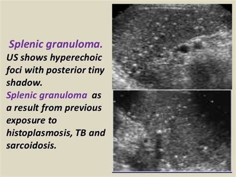 Splenic granuloma. US shows hyperechoic foci with posterior tiny shadow. Splenic granuloma as a ...