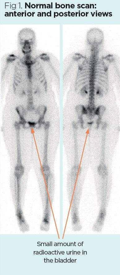 Nuclear medicine 2: principles and technique of bone scintigraphy ...