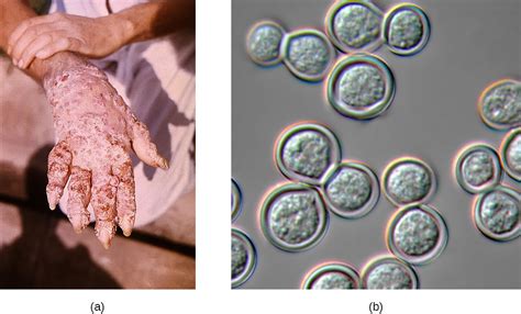 Respiratory Mycoses | Microbiology