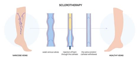 7 Shocking Sclerotherapy Risks and Side Effects: Unveiling the Truth!