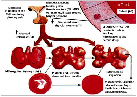 Multinodular Goiter - Endotext - NCBI Bookshelf