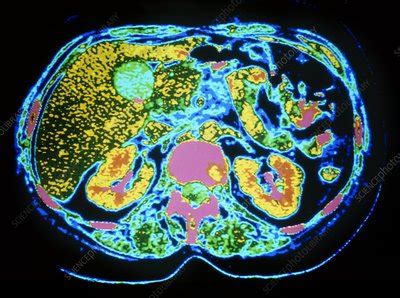 Coloured CT scan of gallstone in liver - Stock Image - M165/0138 - Science Photo Library