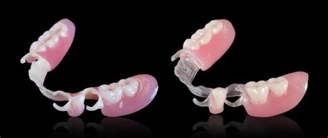Partial dentures cost - Steps for partial denture - Bauer Smiles