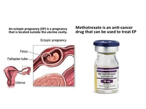 Methotrexate to treat ectopic pregnancy | Ectopic pregnancy, Pregnancy information, Pregnancy