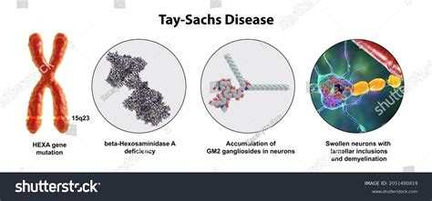 108 Tay sachs disease Images, Stock Photos & Vectors | Shutterstock