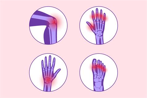 What You Need to Know About Gout in Women - Helping Network Foundation