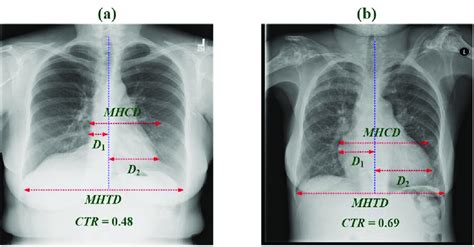 Cardiothoracic ratio (CTR) estimation on posteroanterior chest X-ray... | Download Scientific ...