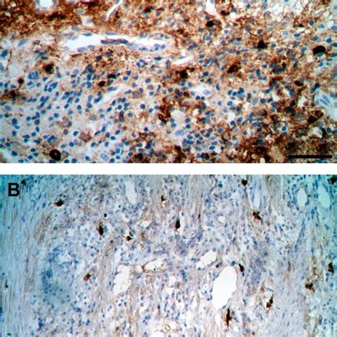 Immunohistochemistry with mast cell tryptase antibody showing mast cell ...