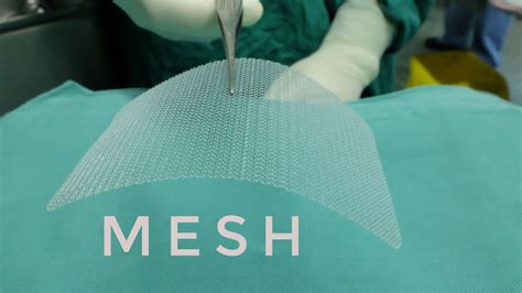 Hernia Mesh Lawsuit Update 2024 - Nissy Andriana