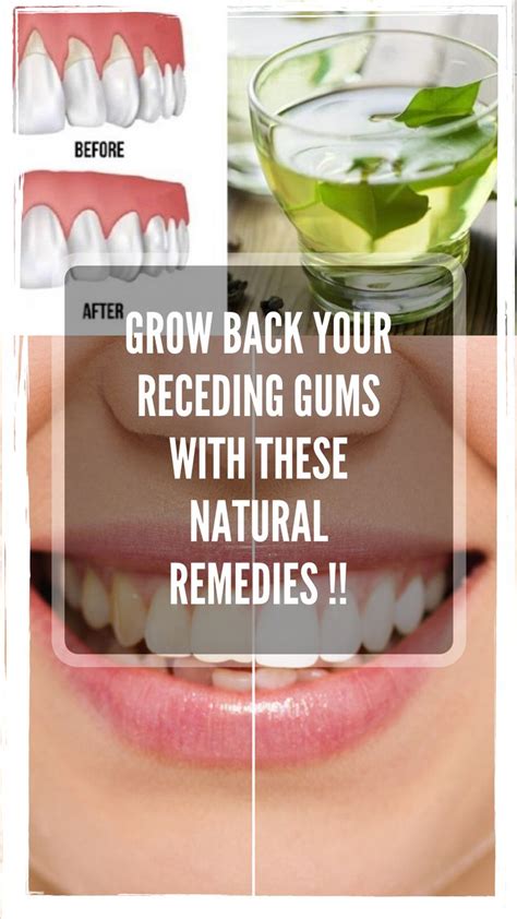 GROW BACK YOUR RECEDING GUMS WITH THESE NATURAL REMEDIES !! | Receding gums, Remedies, Gum