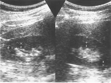 The sonographic view of the measurement of renal cortical thickness in... | Download Scientific ...