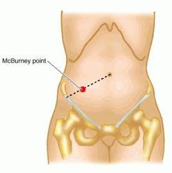 McBurney point - definition of McBurney point by Medical dictionary. a ...