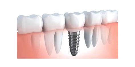 Dental Implants in Boston, MA | Lucca Oral & Facial Surgery