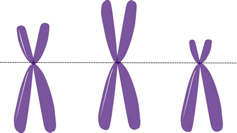 Ring #Chromosome and Clinical Findings « OMICS Journals