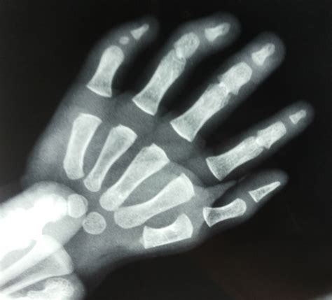 Fusion Of Interphalangeal Joints | Spot Diagnosis | Pediatric Oncall