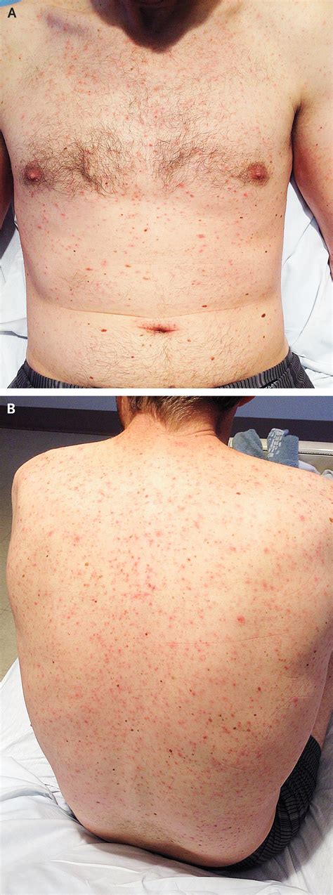 Case Challenge — A Man with Fevers, Rash, Pancytopenia, and Abnormal Liver Function — NEJM