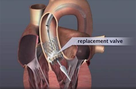 Transcatheter Heart Valves | HYGEIA Hospital