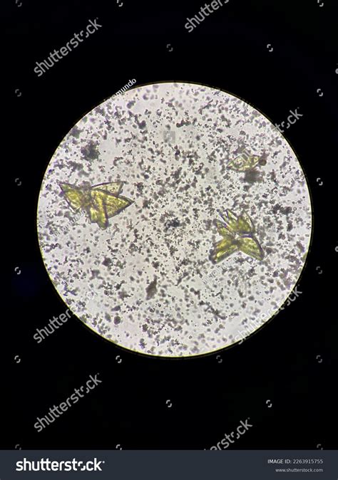 Uric Acid Crystal Amorphous Urine Microscopy Stock Photo 2263915755 ...