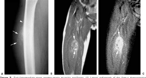 Myositis Ossificans | Semantic Scholar