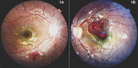 Premacular haemorrhage in a child with Evans syndrome | BMJ Case Reports