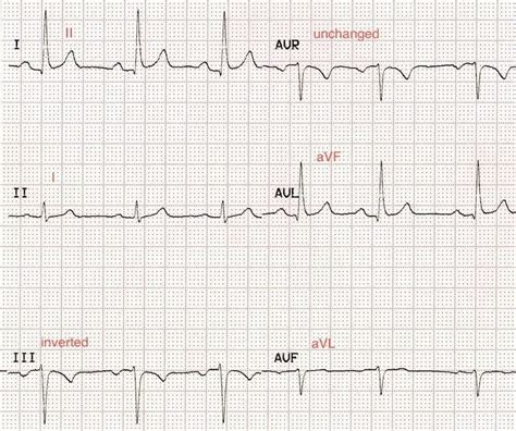 ECG Limb Lead Reversal • LITFL • ECG Library Diagnosis