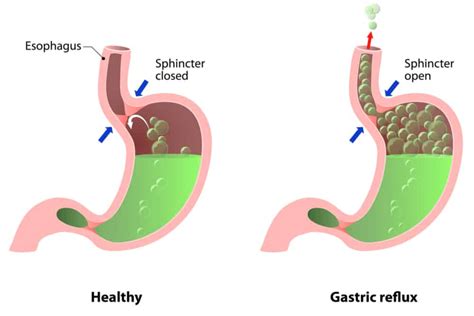 Lower Esophageal Sphincter Dysfunction: Everything You Need To Know