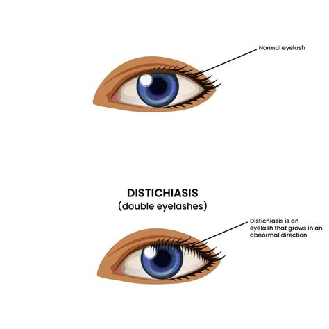 Double Eyelashes (Distichiasis) - Why Does It Happen?