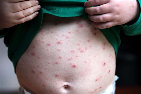 Where does chickenpox start? Advisers tell NHS to give toddlers ...