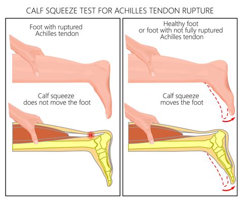 Ankle - Orthopaedic Center of the Virginias