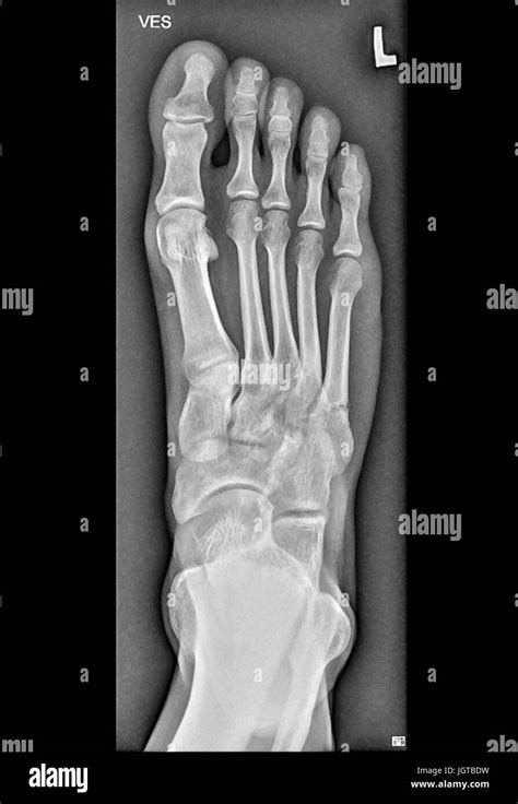 Foot Medical Xray, broken bone, Patient treatment Stock Photo - Alamy