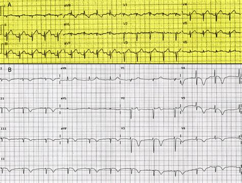 Coronary vasospasm and concurrent Takotsubo cardiomyopathy - The ...