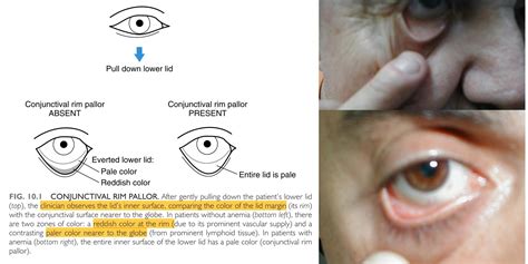 Anemia – Allan J. Goody Bedside Medicine Series