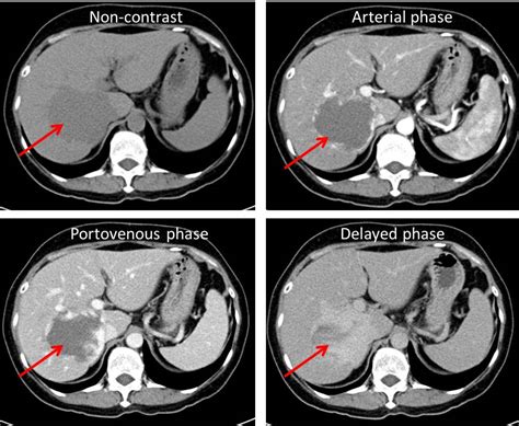 Hepatic venous malformation (hemangioma) – Radiology Cases