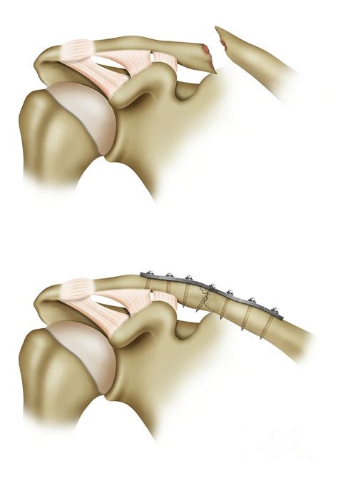 Clavicle Fracture Repair Surgery Photograph by Maurizio De Angelis/science Photo Library