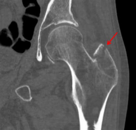 Greater Trochanter Avulsion Fracture