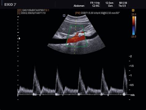 Ultrasound images • Celiac artery, CFM & PW, echogramm №494