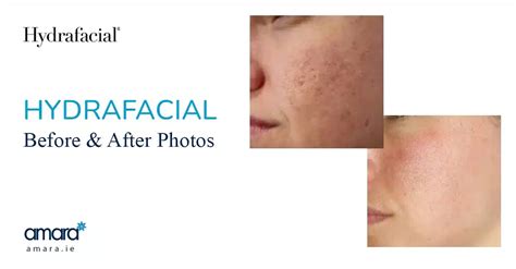 Hydrafacial Before and After Photos | Amara Skincare Dublin