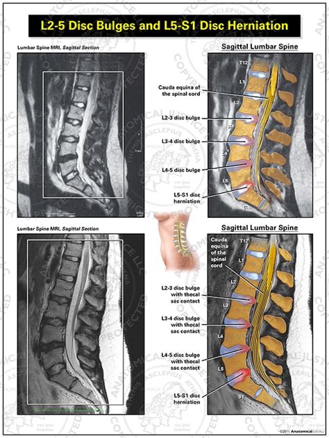 L2-5 Disc Bulges and L5-S1 Disc Herniation