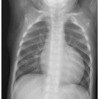 Chest X-ray showing severe cardiomegaly. | Download Scientific Diagram