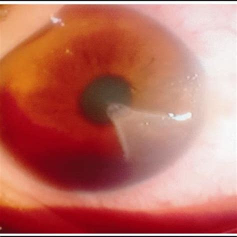 Lamellar corneal laceration with hyphema. | Download Scientific Diagram